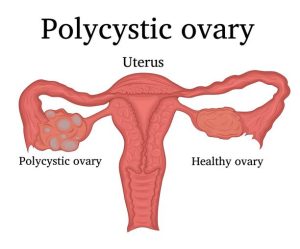 infertility
